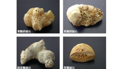 結(jié)石治療最佳方案