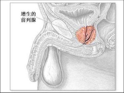前列腺增生