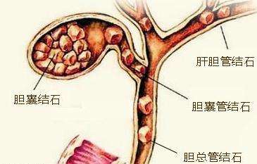 膽囊結(jié)石的癥狀