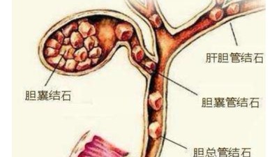 膽囊結石可以不切膽嗎？